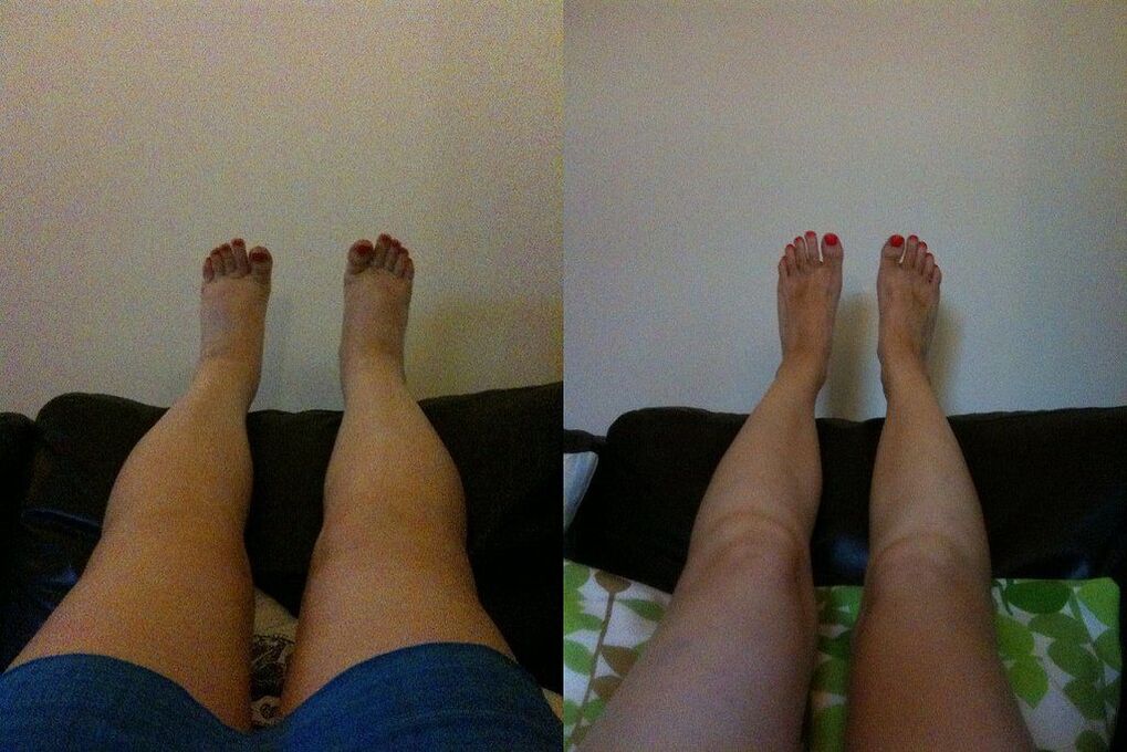 Effective result before and after application of Margarita's Ostelife Premium Plus cream