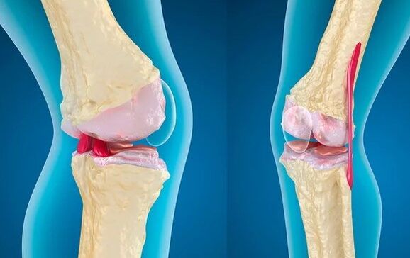 Gonartrosis of the third degree of knee articulation