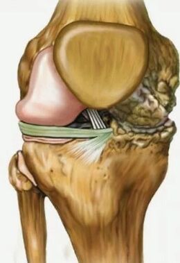 Knee articulation arthrosis