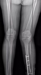 Knee deformations