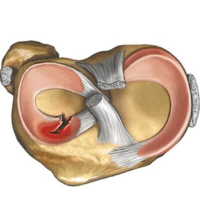 Menisc injury