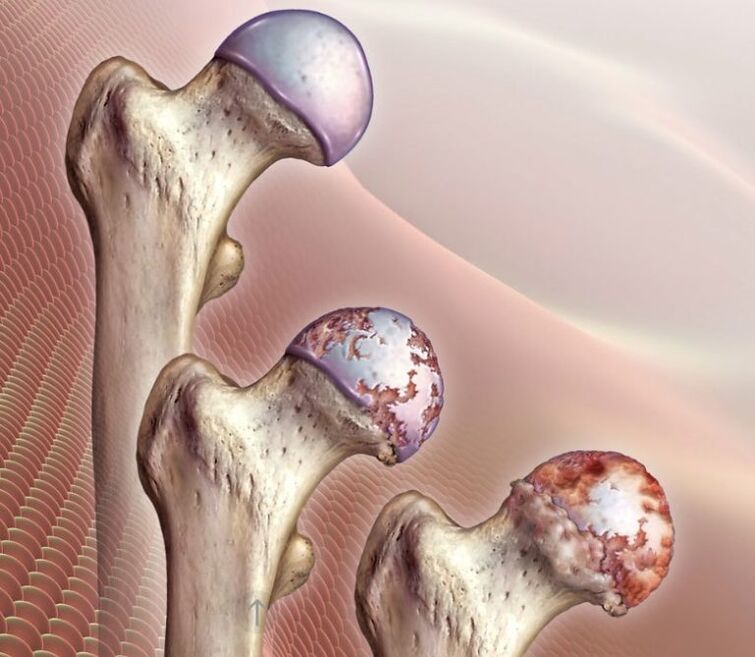 Hip Articulation Arthrosis