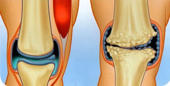 The normal articulation condition and the causes of knee arthrosis development