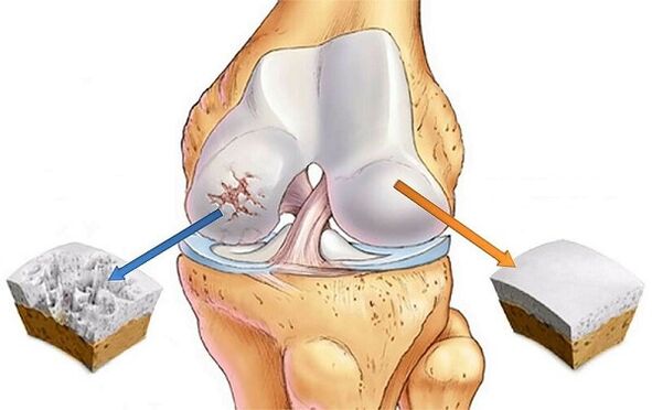 norm and deviation for knee joint arthrosis