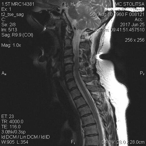 Osteochondrosis and sprinkles of the cervical spine