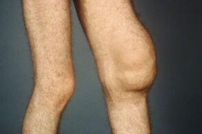 The causes and symptoms of knee joint arthrosis