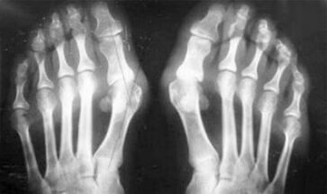 Differential diagnosis of symptoms of arthritis and arthrosis