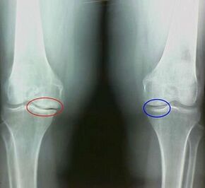 The result of the treatment of popular remedies of arthritis and arthrosis