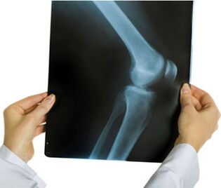 X-ray of arthrosis of the knee joint