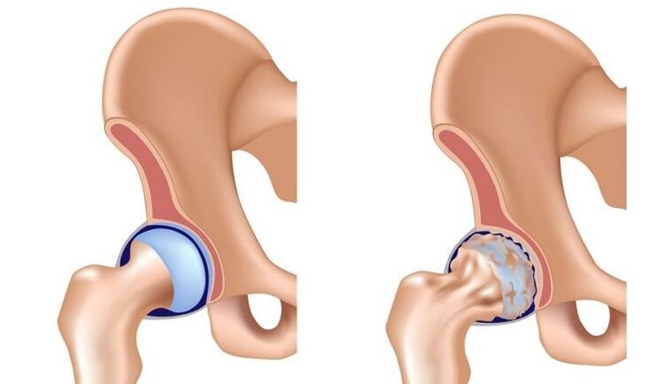Healthy and articulate with arthrosis