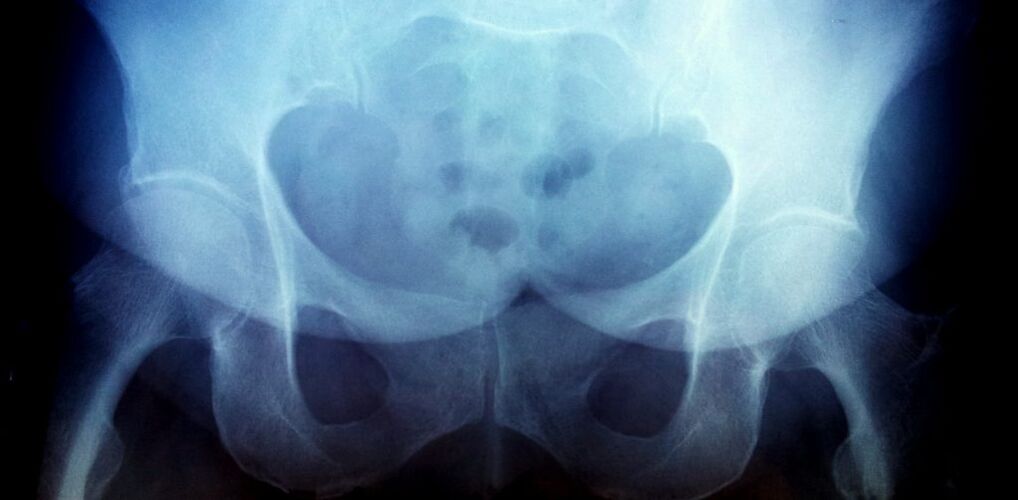 Image x -Ray with 2nd degree arthrosis